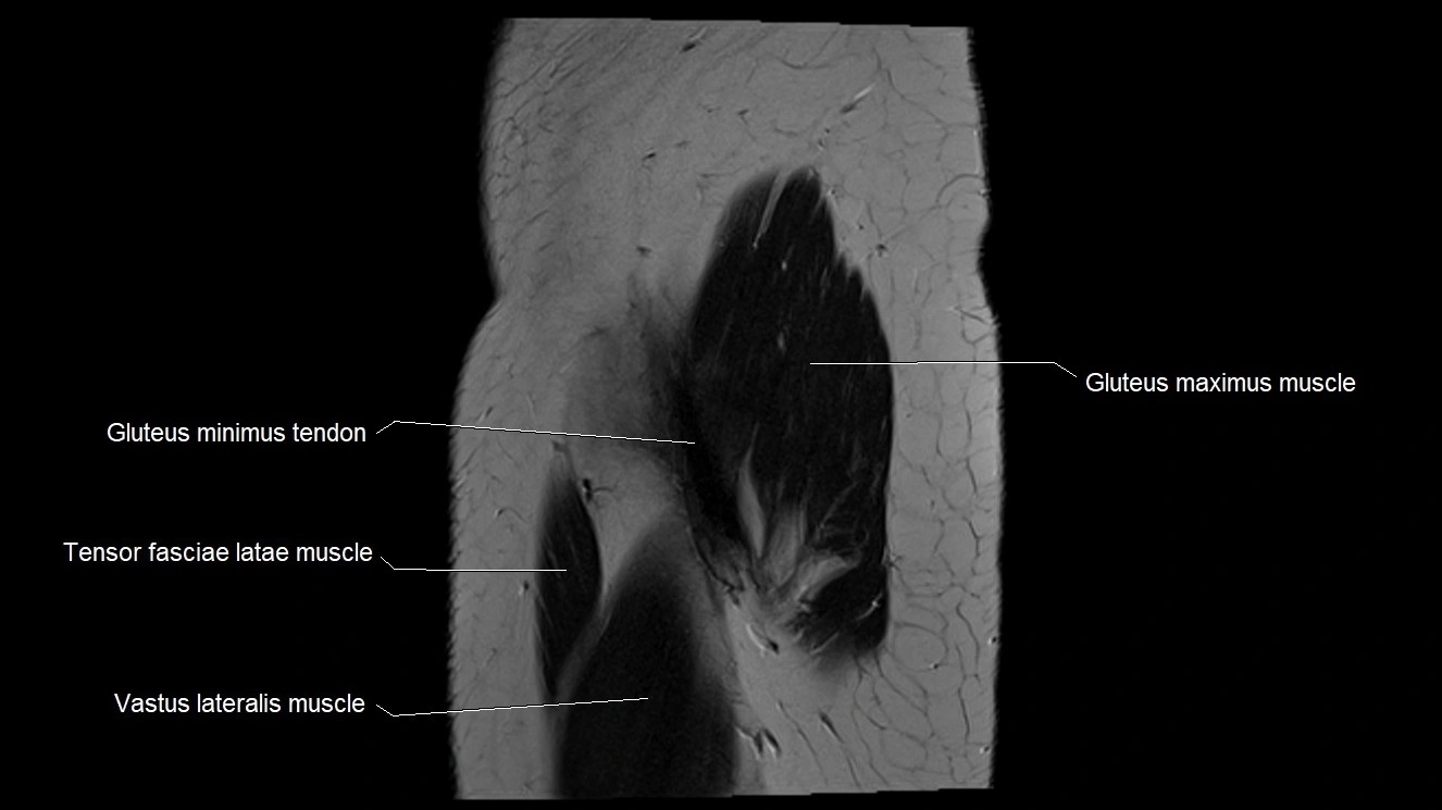 Hip sagittal cross sectional anatomy image 3.webp